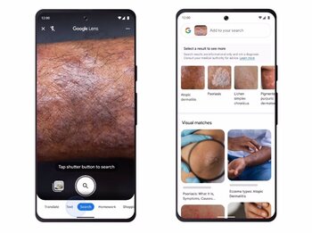 Google Lens permite identificar afecciones dermatológicas